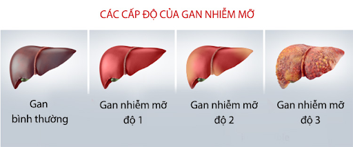 Gan nhiễm mỡ có mấy giai đoạn? Câu trả lời sẽ có tại đây!